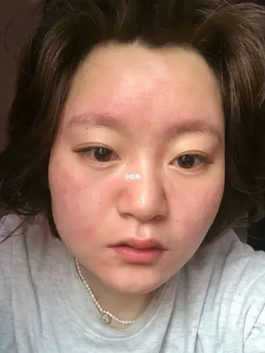 这是我经历的第二次皮肤屏障受损_过敏_药膏_屏障受损_化妆_薇诺娜