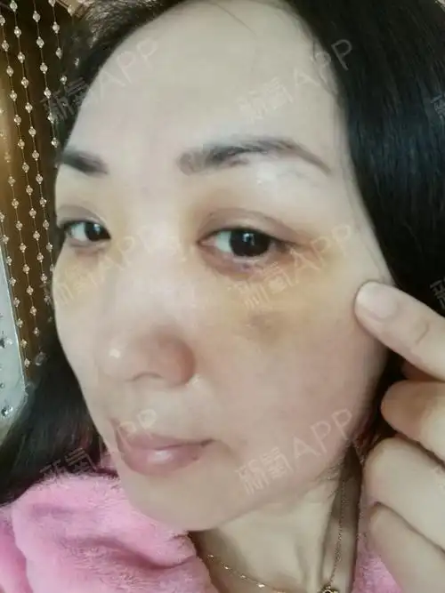 眼部溶脂,泪沟填充术后五天,我又来更新日记啦.