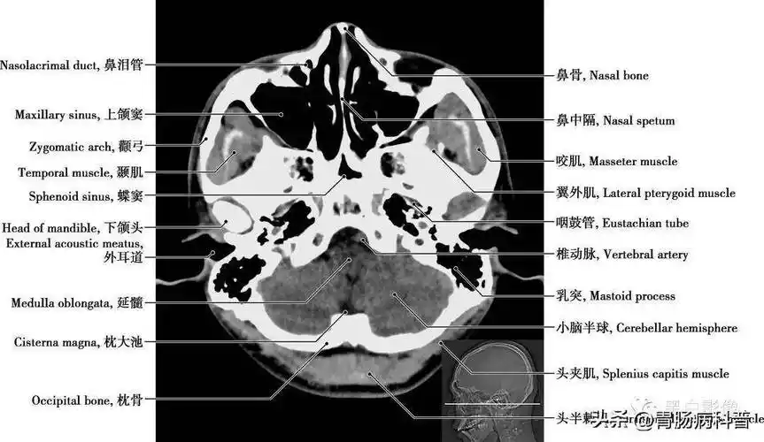 详细标注版——颅脑ct正常解剖图谱_中央_小脑_纤维