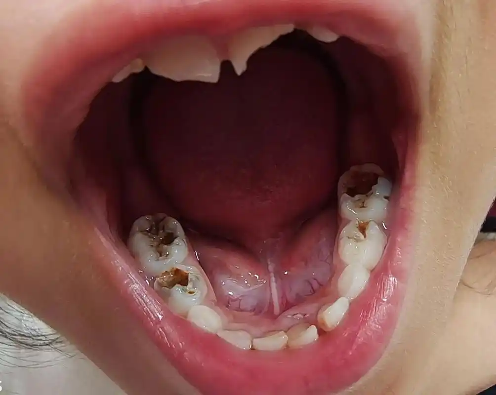 有没有同款牙齿?这牙该怎么办?疼得哭闹就是不配合,是不是不管 - 抖音