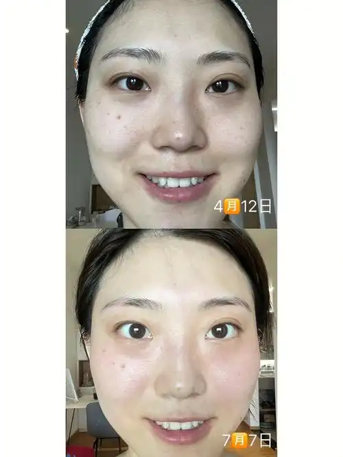 之前没拍图就拿4月份的一张出来做对比脸部的毛孔比之前要细腻了一些