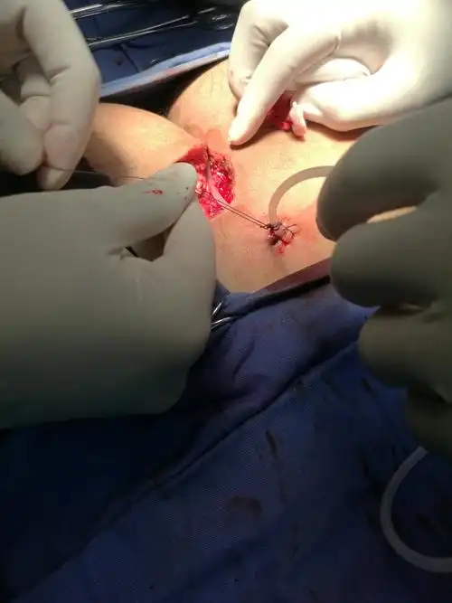 2019年8月21日双藏毛窦切除缝合术