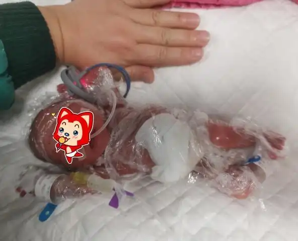 白银市妇幼保健院市一院西院区成功救治一例孕30周1kg早产儿