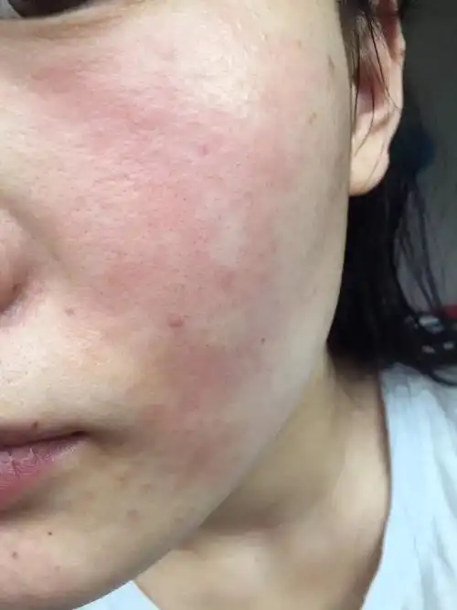一开始脸非常痒,很红,抹上霜会很痛,几天后脸开始脱皮.