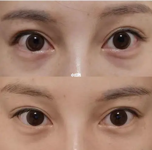 嗨体去泪沟对比