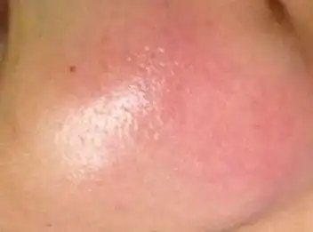 那么,皮肤过敏急性疾病 皮肤过敏 知识 03阅读:急性过敏怎么办    1