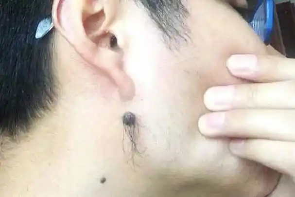 痣上长毛,是福还是祸?