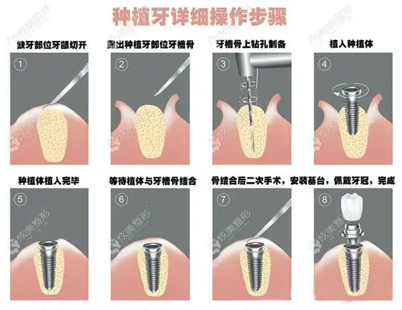 北京佳美口腔的收费标准调整:韩国,瑞士进口种植牙的价格有变化哦