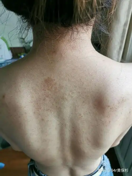 毛囊炎的症状是什么样子的怎样治疗