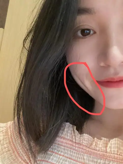 想问下大家,笑起来的这块是啥?酒窝也不长这样