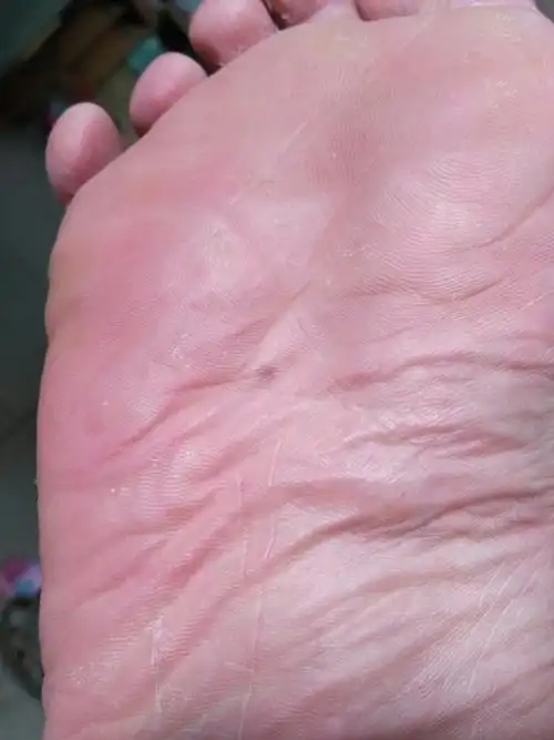 右脚掌有痴,有懂的么?什么命运?_百度知道