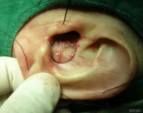 【经验交流】耳廓肿瘤手术 有意思带蒂肌皮瓣 11-11 14:29