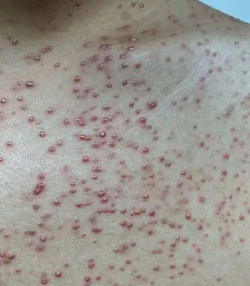 前胸后背总是冒痘痘,其实是由马拉色菌引起的毛囊感染据研究,人体胸背