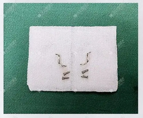 做颧骨内推手术三年后取钛钉会不会剥离大造成二次创伤呢