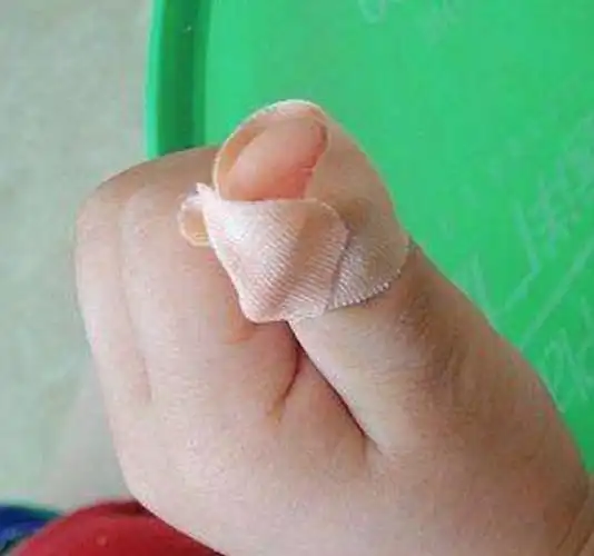 贴个创可贴,4岁女孩竟要截肢!武清人注意,千万别这样包扎伤口