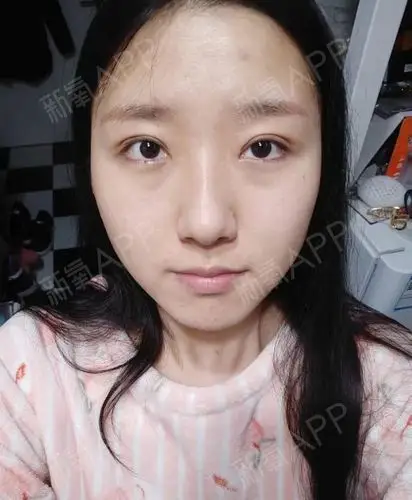 术前;上眼脸下垂严重,眼肌无力脂肪厚.全切双眼皮 _圈子-新氧美容整形