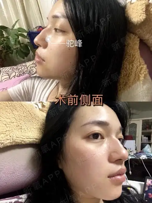 为什么有些明星的驼峰鼻也能很好看,而我的驼峰鼻却这_圈子-新氧美容