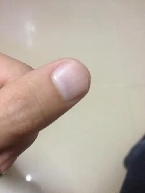 指甲这样正常么