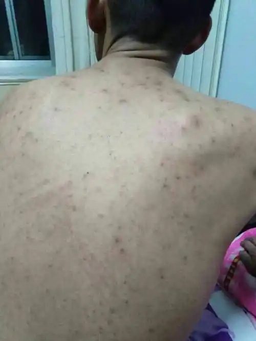 后背总是不断的鼓这种疙瘩 疼痒 20多年了 一直没找到病因 请老师们