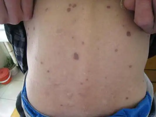 艾滋病红疹症状图片 (6)