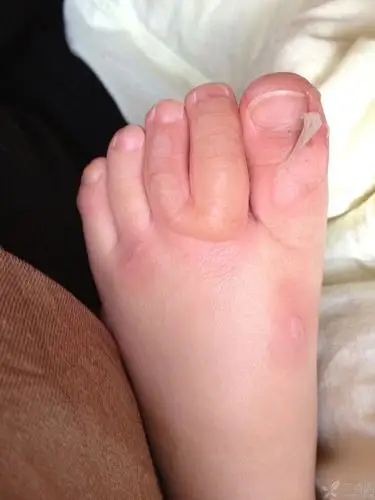 两岁小朋友脚被开水烫伤**处理方法