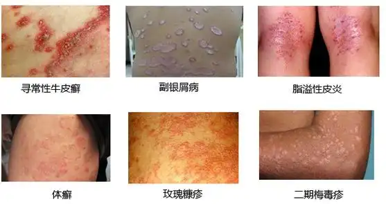 多基因遗传的慢性皮肤炎症性疾病,不是传染病,所以不会传染他人,在一