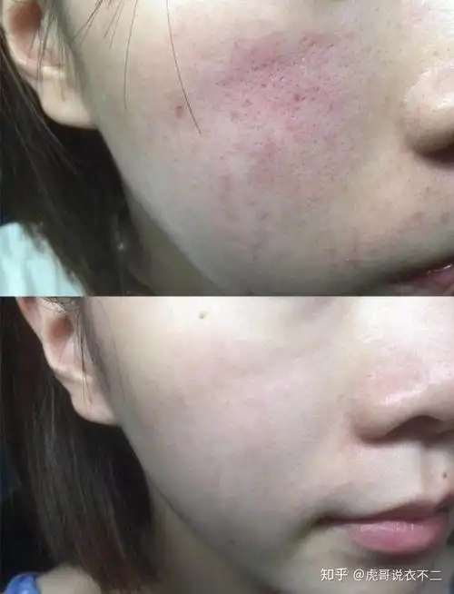 拯救皮肤屏障受损从此告别红血丝做个满脸胶原蛋白的仙女