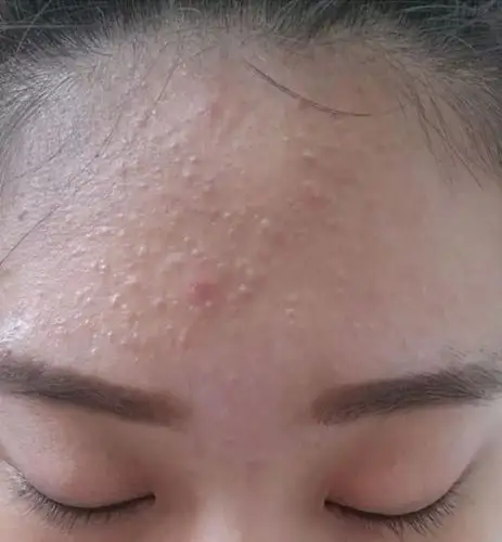 关于治闭口作为刚刚小有成效的我有话要说