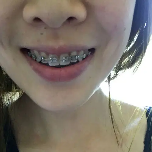 每次去牙医那里调整 这里调整好了 那里又出问题 现在虎牙特别长 门牙