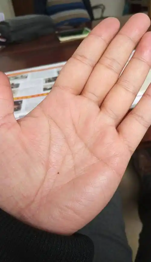 所谓"手背有痣表示才华,手心有痣表示富贵",就是说手背有痣的人足智多