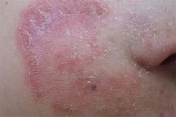 寻常型皮肤癣图片