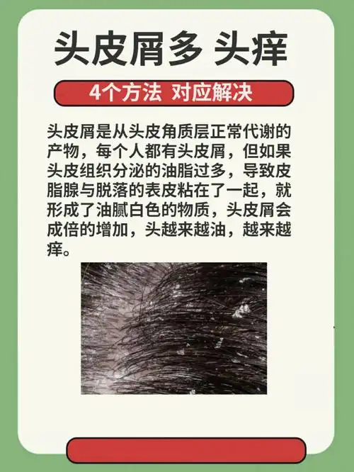头皮屑多头痒4个方法轻松解决