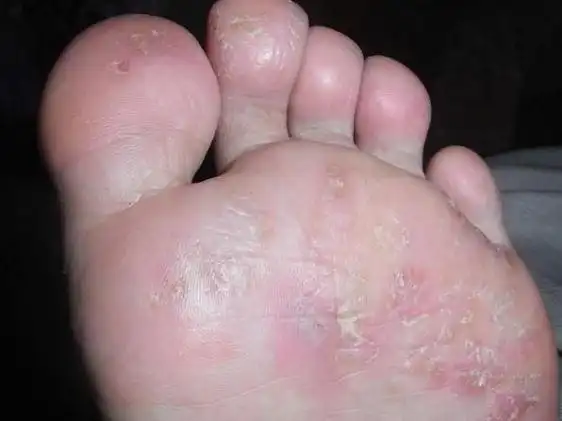 脚上起小水泡湿疹不痒该如何治疗