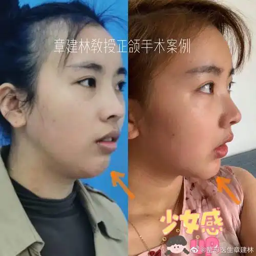 正颌手术前后侧面对比