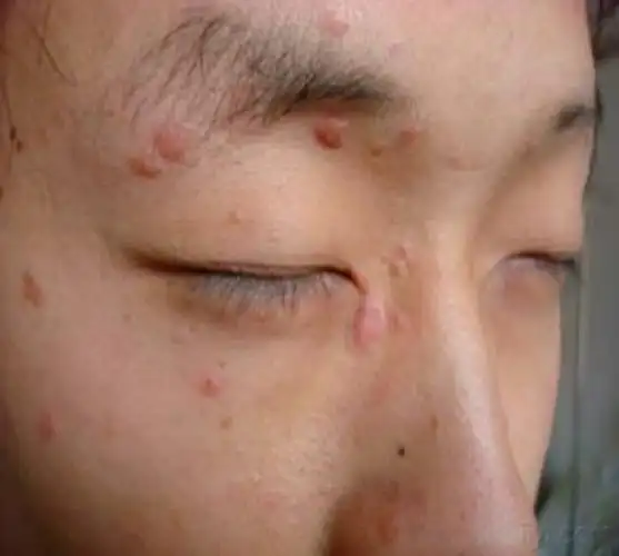 脚部扁平疣症状图片