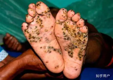 给人取寄生虫视频医生拿镊子取寄生虫2022已更新今日更新