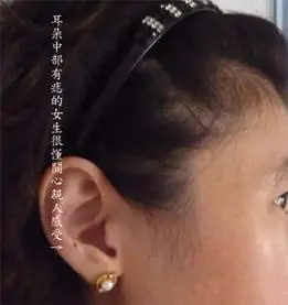 额头,火星丘黑痣,生命线岛纹及聪明痣详解