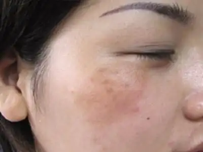 经常喝三七粉祛黄褐斑的女性皮肤怎样了日本给出答案