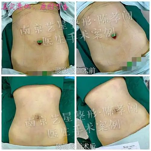 腰腹部环吸塑型