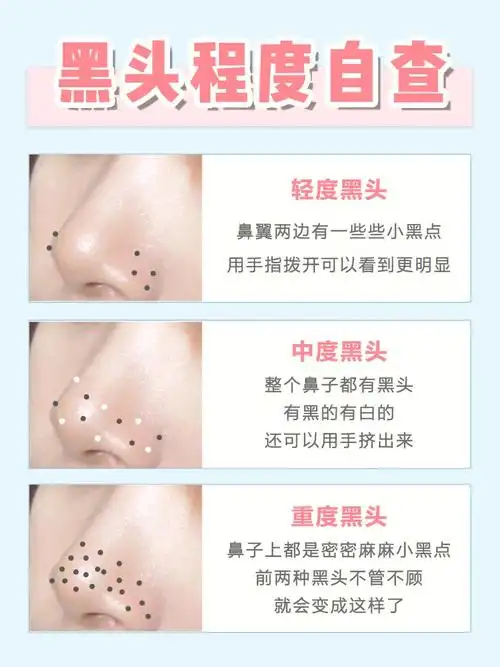 挤黑头达咩74教你几招科学去黑头60科普干货