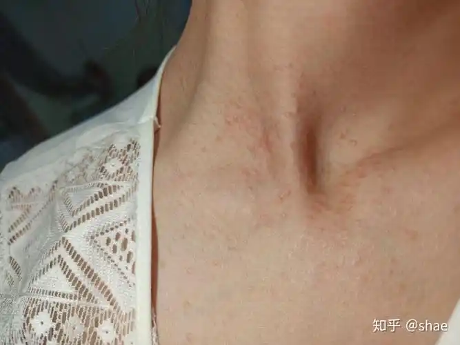 皮肤问题粟丘疹