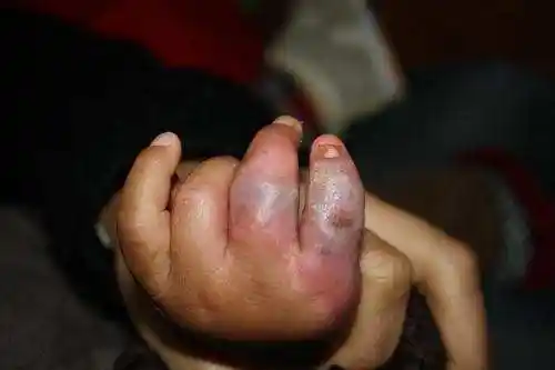 2岁宝宝手部化脓感染啼哭不止, 家里有它的家长要注意了!