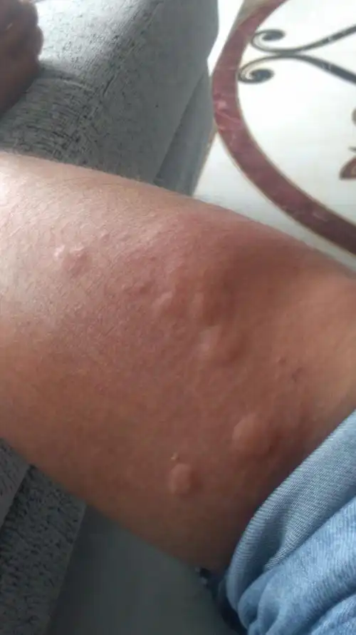 皮肤瘙痒吃了过敏药放了硫软膏和无极膏还是一样肿胀