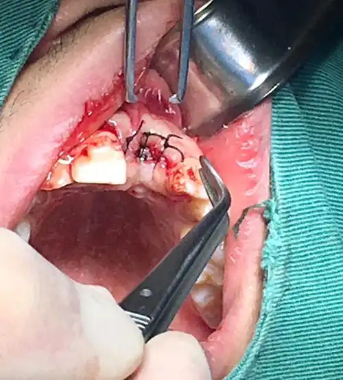 手术结束,给予缝合