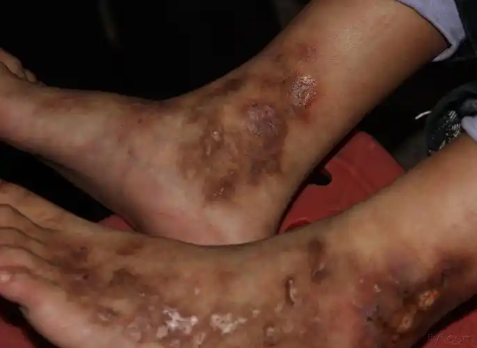 我也来晒晒图片(五十九)——白色萎缩 - 皮肤及性传播疾病讨论版