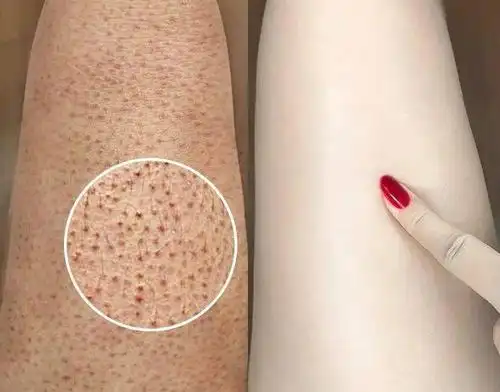 身体"橡皮擦",10年老角质30秒自动溶解!"磨"掉关节暗黑,鸡皮肤!