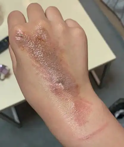 您好我手被电器烫伤了这种情况需不需要去医院目前是用碘伏消毒