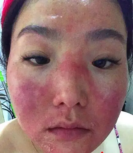 【感谢贴】脸干燥起皮红痒怎么办?我的经历:不好好护理真的会烂脸!