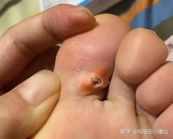 鸡眼是什么,请问鸡眼是什么感觉?