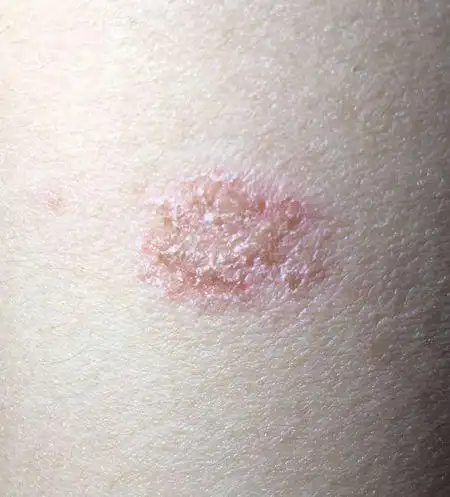 去了趟甘肃,手臂上就长出了这么个东西,不疼不痒,长宽大概1cm,开始